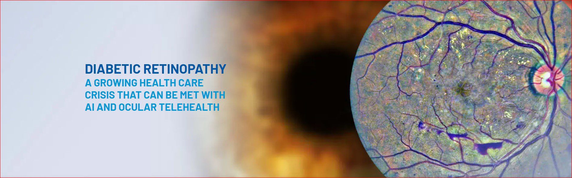 diabetic retinopathy